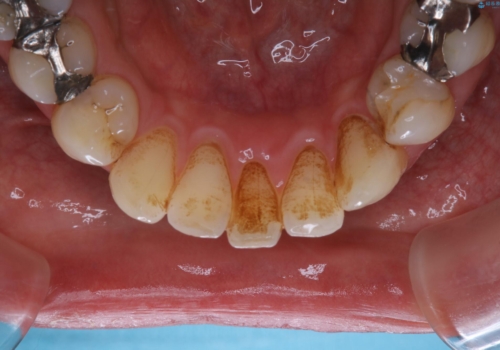 虫歯や歯周病予防のためにクリーニングを(PMTC)の治療前