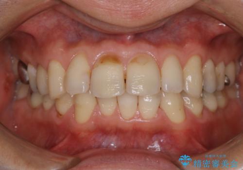 虫歯や歯周病予防のためにクリーニングを(PMTC)