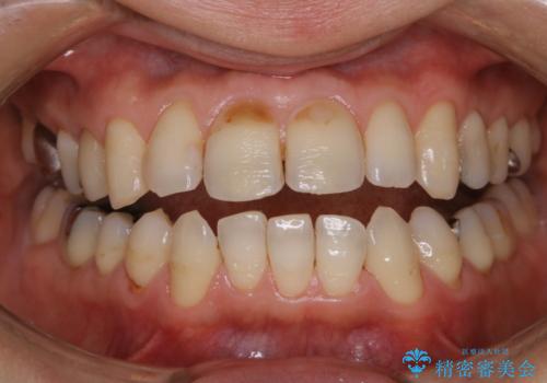 虫歯や歯周病予防のためにクリーニングを(PMTC)の治療後