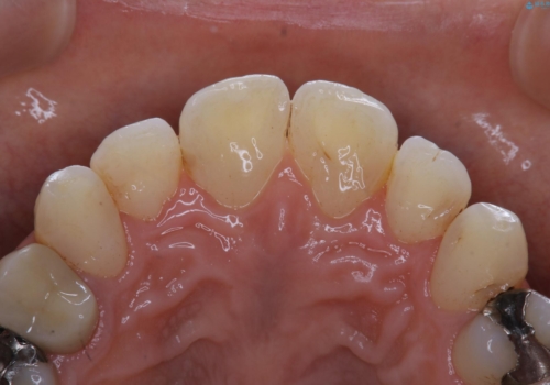 虫歯や歯周病予防のためにクリーニングを(PMTC)の症例 治療後