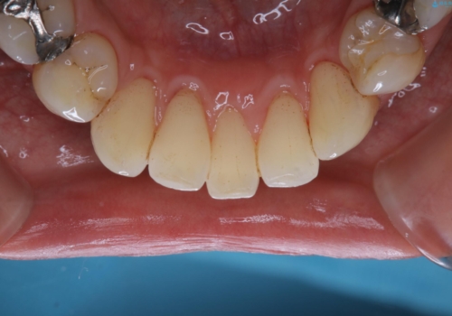 虫歯や歯周病予防のためにクリーニングを(PMTC)の治療後