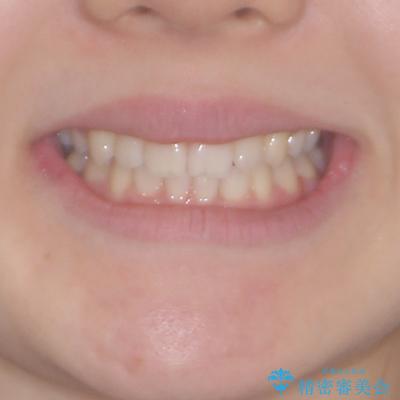 目立つ八重歯を目立たない装置で　ハーフリンガルによる抜歯矯正の治療後（顔貌）