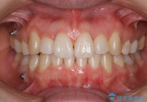 インビザラインの新しいマウスピースが届く前にクリーニング(アタッチメントが外れている時に)