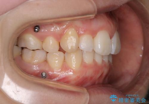 インビザラインの新しいマウスピースが届く前にクリーニング(アタッチメントが外れている時に)の治療後