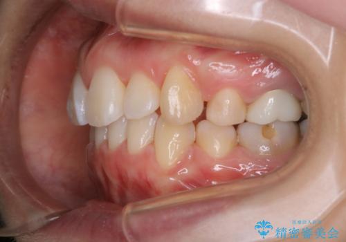 インビザラインの新しいマウスピースが届く前にクリーニング(アタッチメントが外れている時に)の治療後