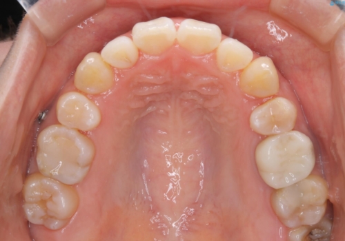 インビザラインの新しいマウスピースが届く前にクリーニング(アタッチメントが外れている時に)の治療後