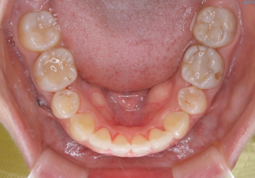 インビザラインの新しいマウスピースが届く前にクリーニング(アタッチメントが外れている時に)の治療後