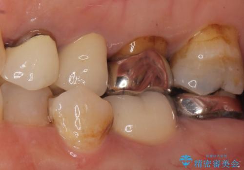 銀歯がノドに飛んできたことがトラウマ ラバーダムをして治療 50代女性の治療前