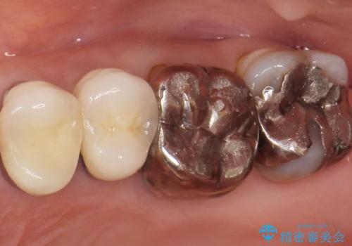 銀歯がノドに飛んできたことがトラウマ ラバーダムをして治療 50代女性の症例 治療前