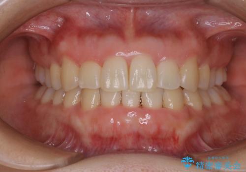 インビザライン・ライトでの抜歯矯正治療 (スリーインサイザー仕上げ)