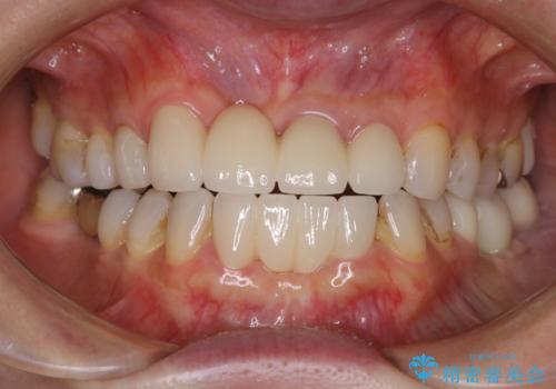 着色落とし(PMTC)