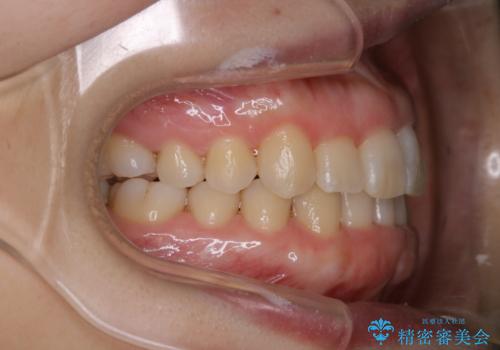 インビザライン・ライトでの抜歯矯正治療 (スリーインサイザー仕上げ)の治療後
