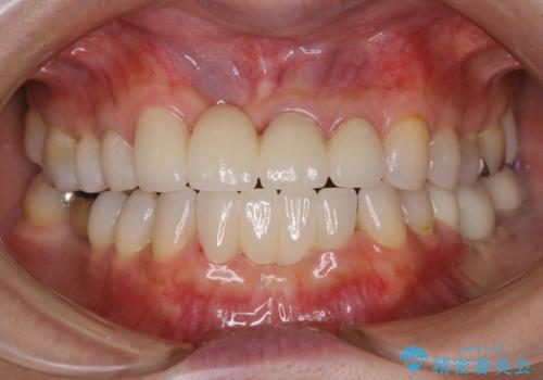 着色落とし(PMTC)の症例 治療後