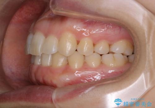 インビザライン・ライトでの抜歯矯正治療 (スリーインサイザー仕上げ)の治療後