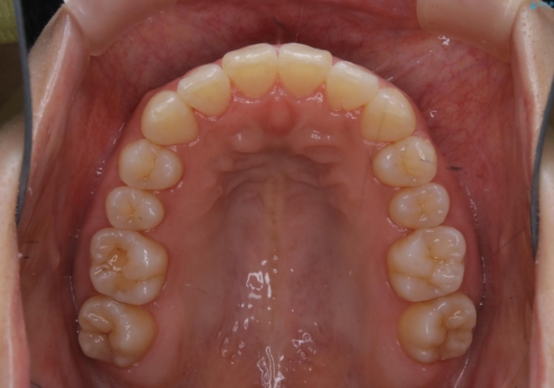 インビザライン・ライトでの抜歯矯正治療 (スリーインサイザー仕上げ)の治療後