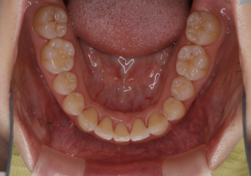 インビザライン・ライトでの抜歯矯正治療 (スリーインサイザー仕上げ)の治療後