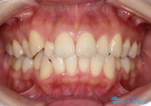 前歯が前後反対にかんでいる　インビザラインによる目立たない矯正の治療前