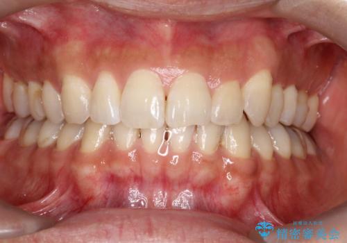 八重歯をインビザラインで矯正　大人の目立たない矯正の治療後
