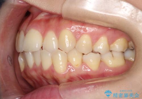 前歯が前後反対にかんでいる インビザラインによる目立たない矯正の治療前