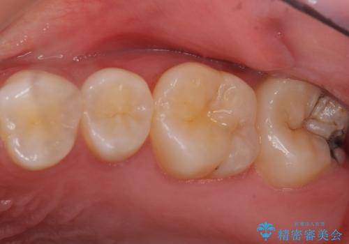 気づかなかった奥歯のう蝕　セラミックインレー　20代女性の症例 治療前
