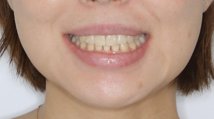 インビザライン・ライトでの抜歯矯正治療 (スリーインサイザー仕上げ)の治療後（顔貌）
