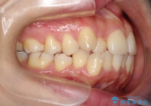 前歯が前後反対にかんでいる　インビザラインによる目立たない矯正の治療前