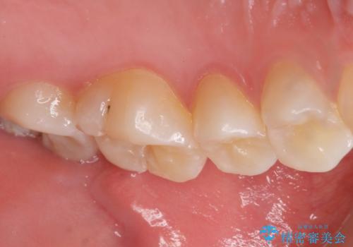 気づかなかった奥歯のう蝕 セラミックインレー 20代女性の治療前