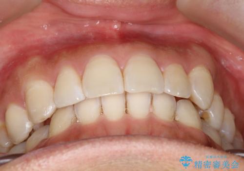 八重歯をインビザラインで矯正 大人の目立たない矯正の治療後