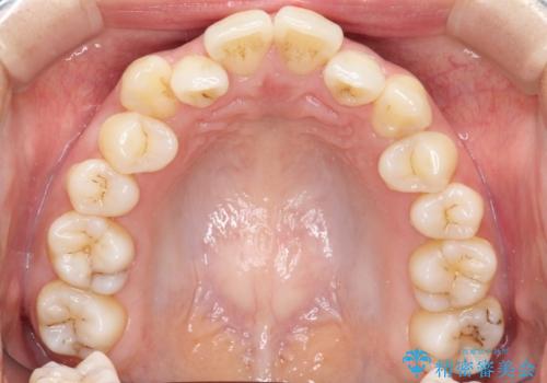 前歯が前後反対にかんでいる インビザラインによる目立たない矯正の治療前
