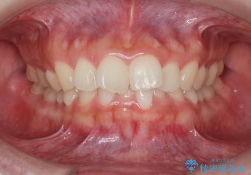 マウスピース　狭窄歯列の改善の症例 治療前