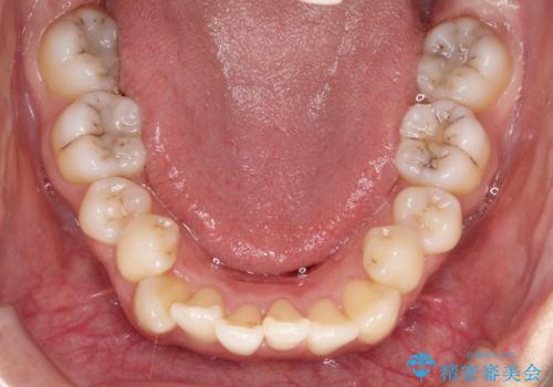 前歯が前後反対にかんでいる インビザラインによる目立たない矯正の治療前