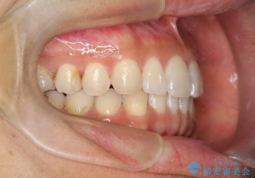 八重歯をインビザラインで矯正 大人の目立たない矯正の治療後