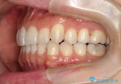 八重歯をインビザラインで矯正 大人の目立たない矯正の治療後