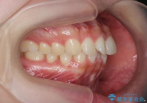 マウスピース 狭窄歯列の改善の治療前
