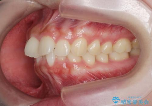 マウスピース 狭窄歯列の改善の治療前