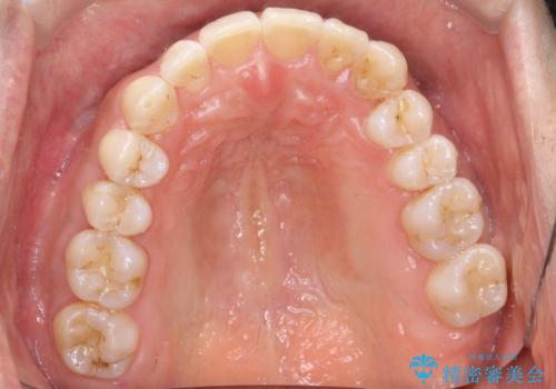 八重歯をインビザラインで矯正 大人の目立たない矯正の治療後