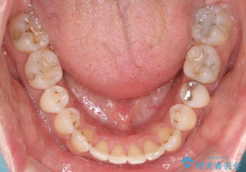 八重歯をインビザラインで矯正　大人の目立たない矯正の治療後