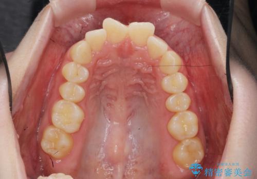 マウスピース 狭窄歯列の改善の治療前