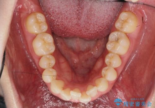 マウスピース 狭窄歯列の改善の治療前