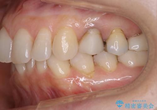 治療後のメンテナンスの治療前