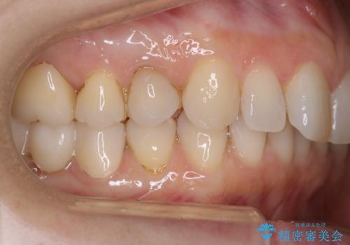 治療後のメンテナンスの治療前