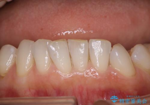 治療後のメンテナンスの治療前