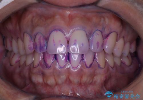 実はこんなに磨き残しが!!!の治療前