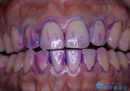 実はこんなに磨き残しが!!!の治療前