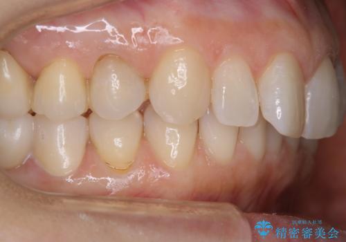 治療後のメンテナンスの治療後