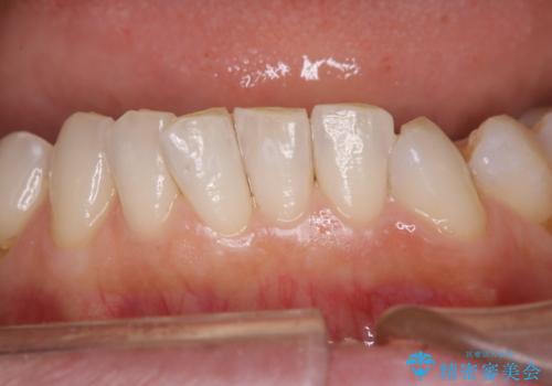 治療後のメンテナンスの治療後