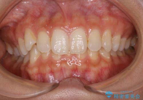 矯正を始める前に歯のクリーニングの治療前