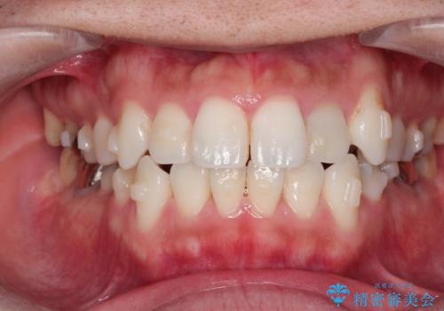 インビザラインで目立たない矯正 ガタガタの歯並びをきれいな歯並びへの治療中