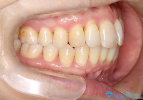 再矯正をインビザラインで目立たず手軽にの治療前