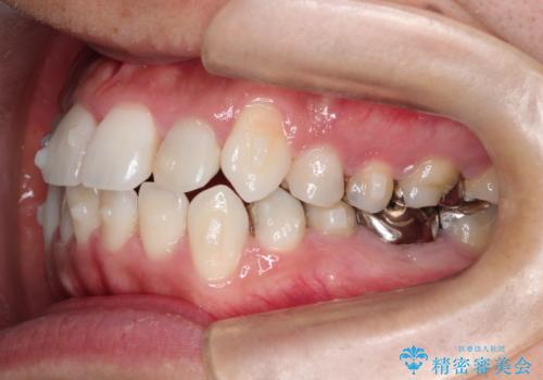 インビザラインで目立たない矯正　ガタガタの歯並びをきれいな歯並びへの治療中